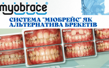 Трейнери «Міобрейс» як альтернатива брекетів