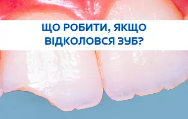 Що робити, якщо відколовся зуб?