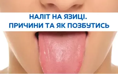 Наліт на язиці. Причини та як позбутись