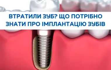 Втратили зуб? Що потрібно знати про імплантацію зубів